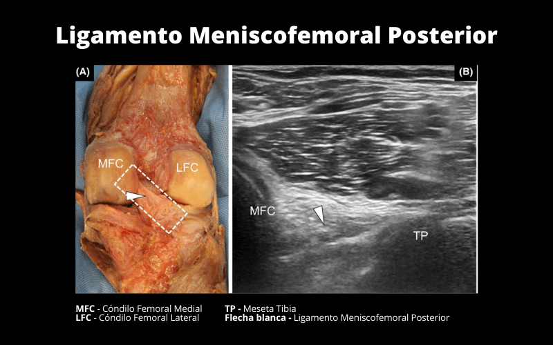 Ligamento Meniscofemoral Posterior.png